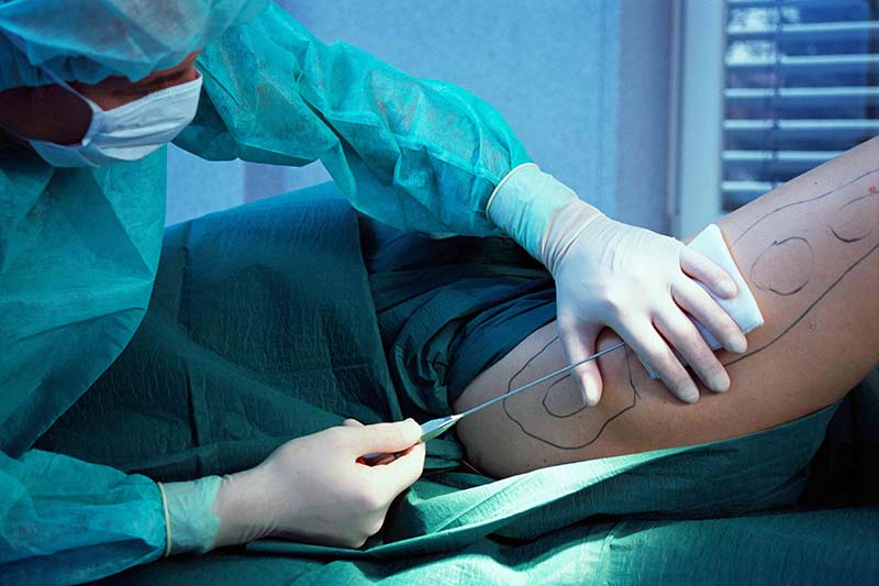 Post Liposuction